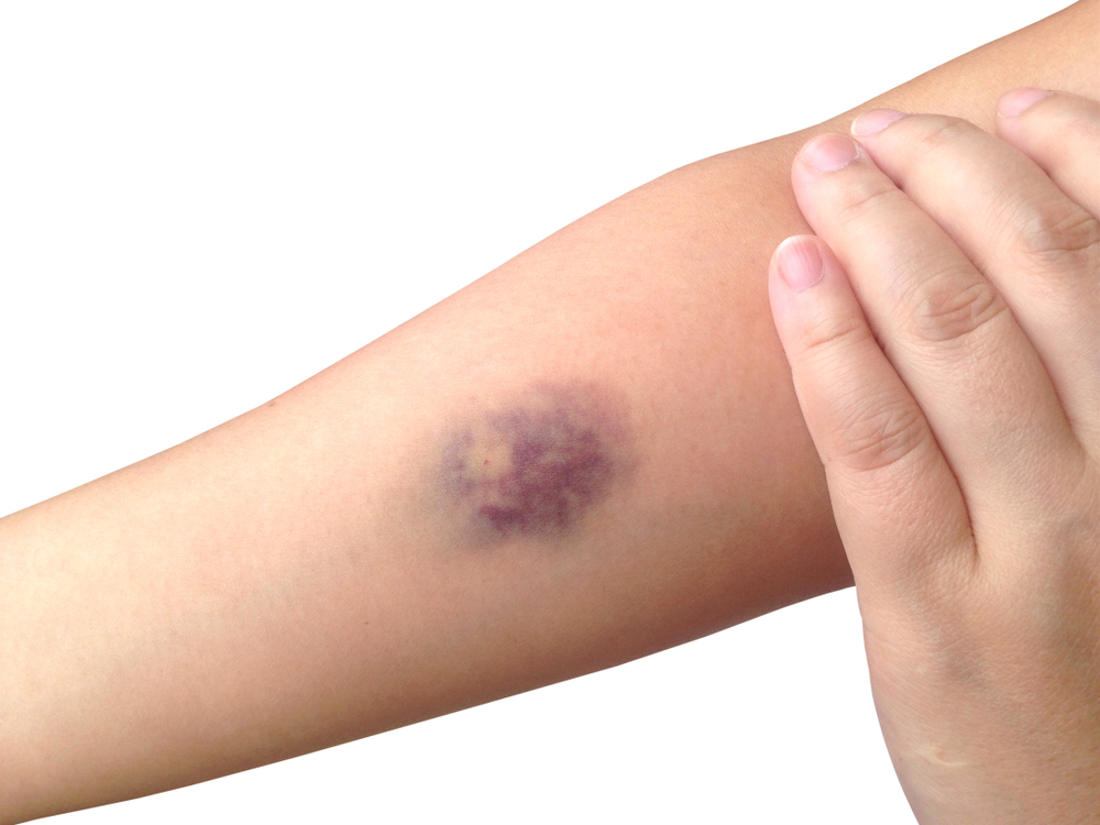 青あざができやすい原因は？消えない青あざは病気の危険性も