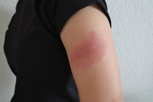 モデルナアームに使えるかゆみ止め薬｜腕の腫れ・かゆみの対処法