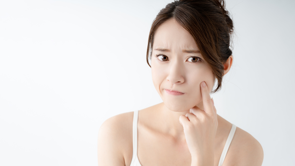 アダパレンゲルは市販されている？ニキビに効く市販薬を紹介