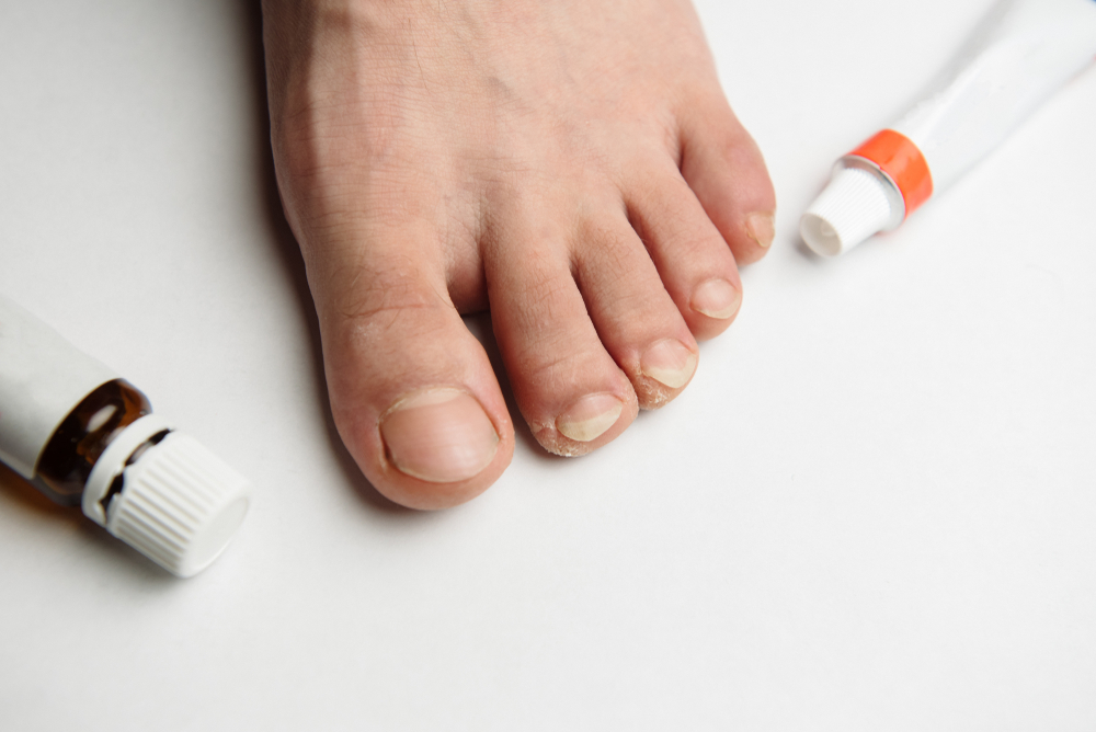 水虫（白癬）に効く塗り薬｜抗真菌成分配合の市販薬を紹介