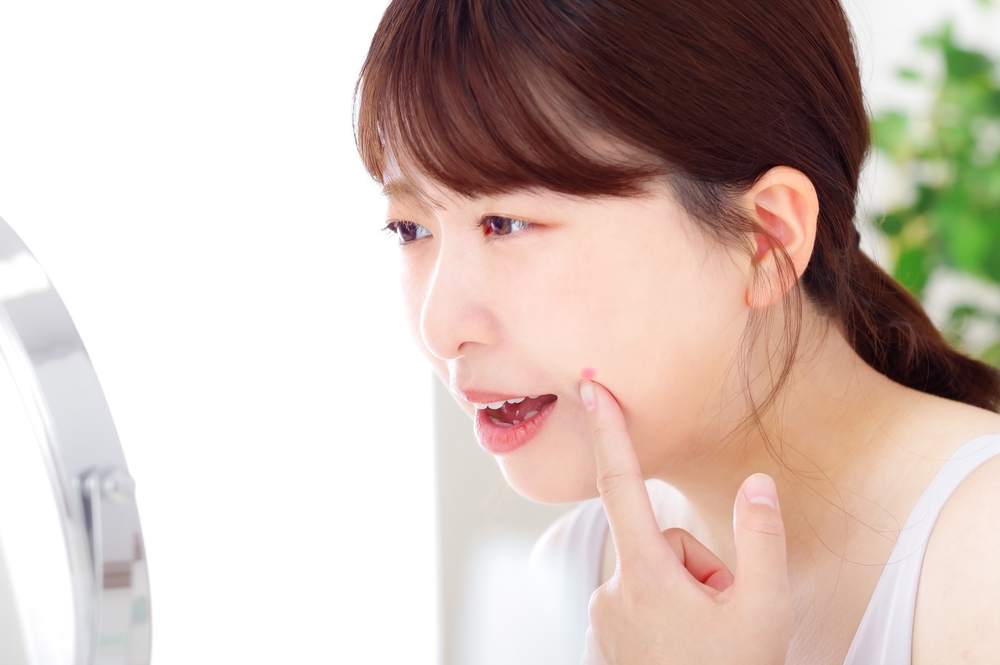 口周りにできたのはニキビ？口唇ヘルペス？それぞれの特徴と違い